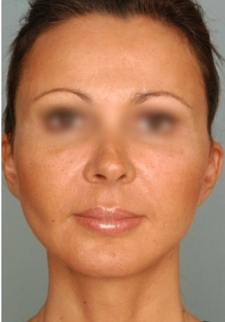 Lifting facial caso 1 — después